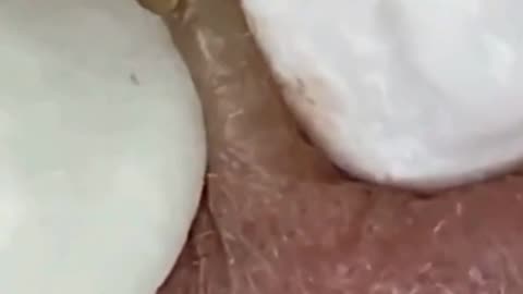 Dr Pimple Popper Removes a Juicy Blackhead