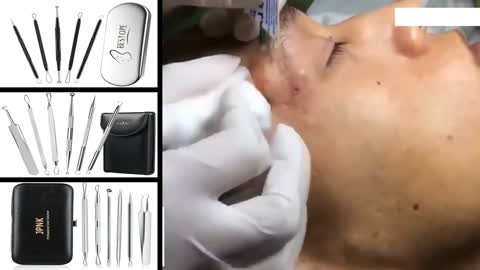 Blackheads Removal & Pimple Popping Videos #2