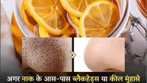 ब्लैकहेड्स हटाने का सबसे अच्छा तरीका Blackhead removal #shorts #blackheads #skincare #ytshorts #diy