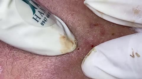 Big Cystic Acne Blackheads Extraction Blackheads & Milia, Whiteheads Removal Pimple Popping