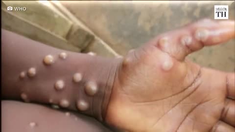 What is Monkey pox virus 🦠🦠🦠 information