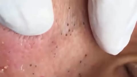 How to Squeeze super big blackhead | AnNa Spa