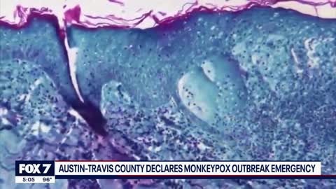 Austin-Travis County declares monkeypox outbreak emergency