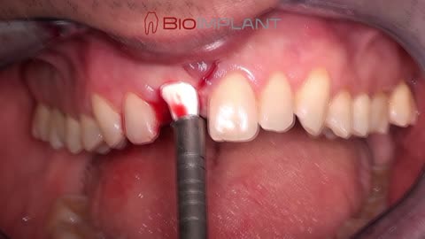 ***THE ONLY DENTAL IMPLANT THAT DOESN’T SCREW YOU! ***