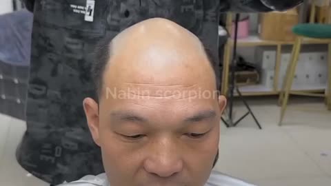 HAIR TRANSPLANT 👍👍👍👍👍👍