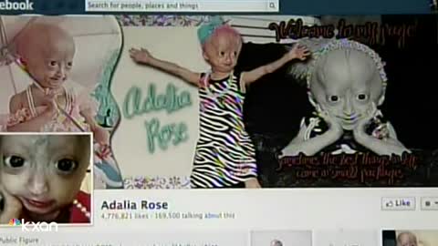 Adalia Rose- Austinite, social media star with rare genetic condition dies at 15