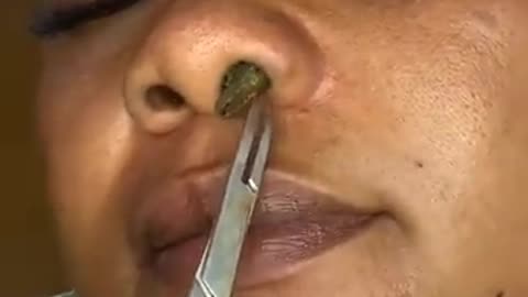 Relaxing with popping the big Blackhead in the nose