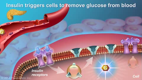 Understanding Type 2 Diabetes