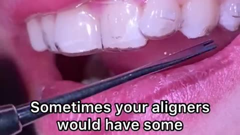 Aligners & Braces Treatment