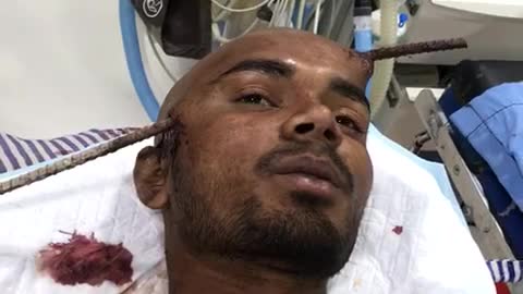 Man impaled by rod in head survives