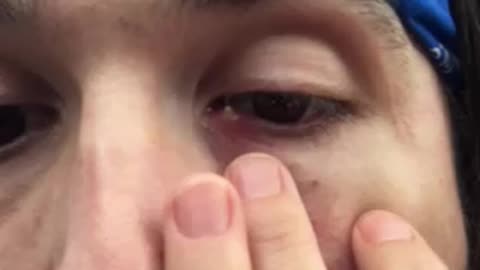 Gross Eye zit