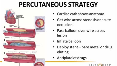 Coronary Artery Disease - Dr. Richard Alexander.