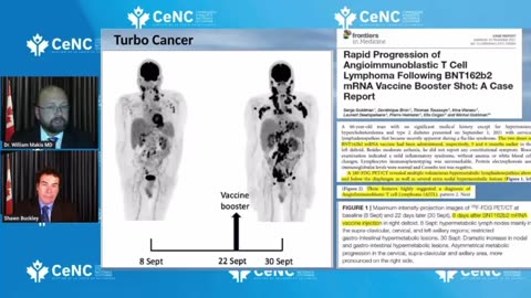 TURBO CANCERS - 66 yr old had 2 Pfizer mRNA Shots, 5 months later presents with tumors