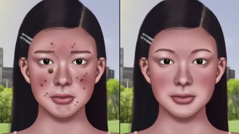 Blackhead & Skin Wart Removal Animation