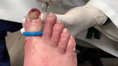 Infected INGROWN Nail From Nursing Home Mistake?