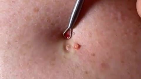 Blackhead Removal, Pimple popping, Acne Treatment #49