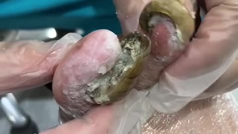 Big toenail removal 👣Toenail removal