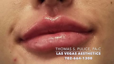 Lip Enhancement Day @ Las Vegas Aesthetics