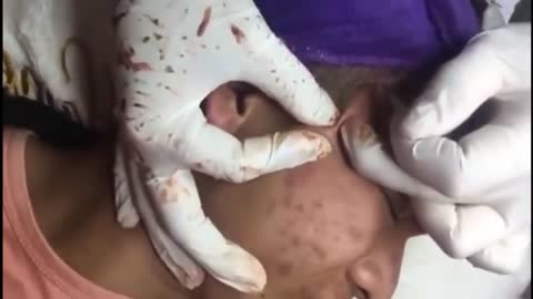 Huge Pimple in Forehead