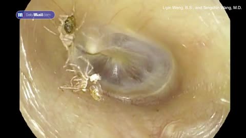 Elderly woman finds SPIDER in ear after hearing clicks for 4 days