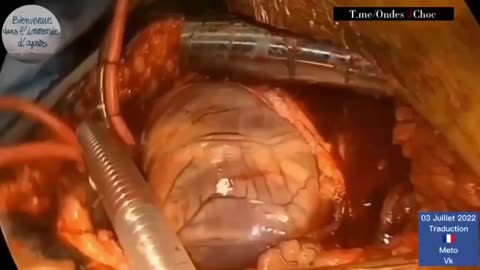 Graphic Warning: A Beating heart with clot being removed