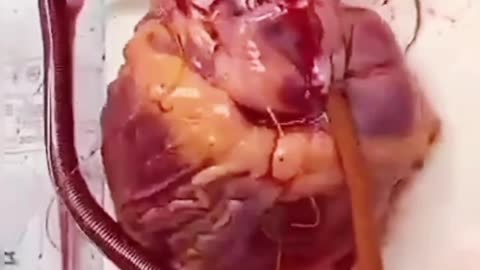 HUMAN HEART 💓 TRANSPLANTING PROCEDURE