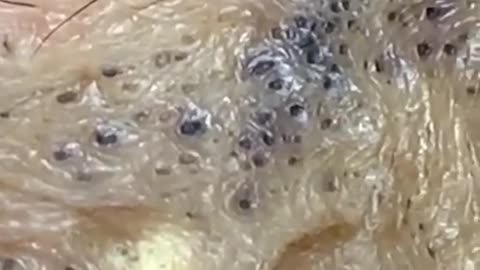 Pimple Popping Blackheads-DOSKf_nCS3k-480p-1655178156087