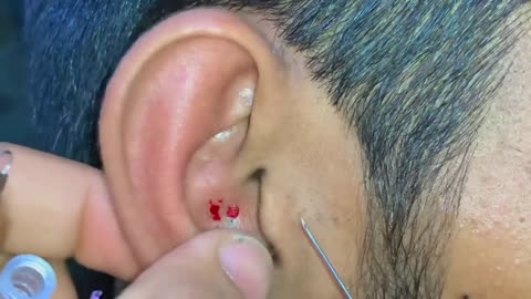 blackheads in Ear Video