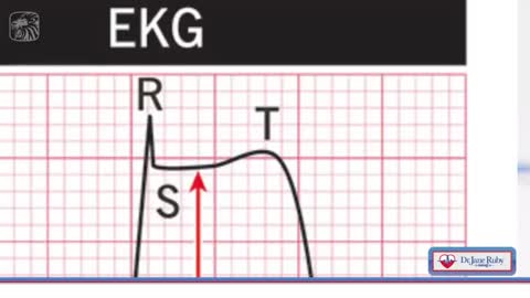 Dr. Jane Ruby Show: Proof: Teens With Myocarditis Are Having Heart Attacks