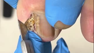 EXTREME INGROWN TOENAIL REMOVAL