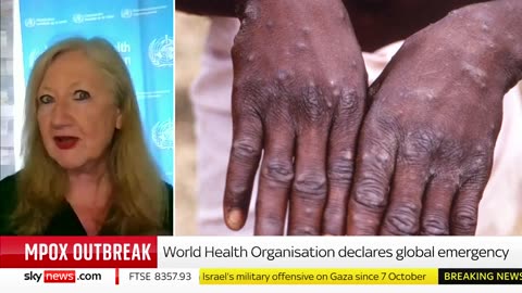 'New variant of mpox spreading very rapidly and could pose threat to rest of world' - WHO