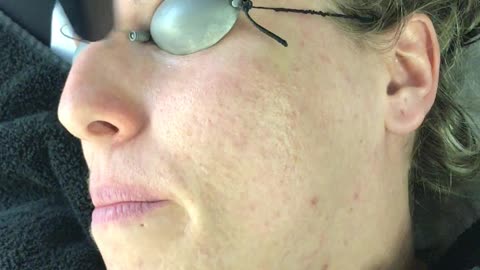 Acne treatment using 104 Q Switch Laser