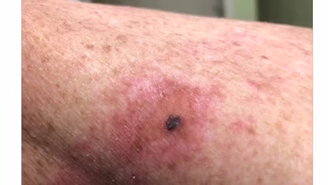 Video Testimonial: Irregular mole removed with the universal antidote. MMS