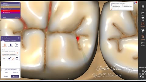 How to design 3 unit 35/36/37 teeth by exocad