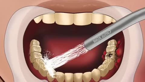 ASMR Treatment of Severe Tooth Decay Part 1 #satisfying #mushroomasmr68 #trendingshorts