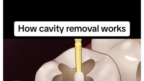 How cavity removal works