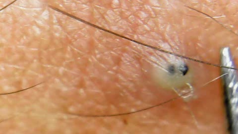 Hidden ingrown hair Under pimple