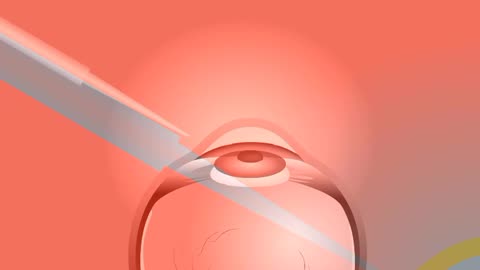 surgical treatment of cataract eye lense