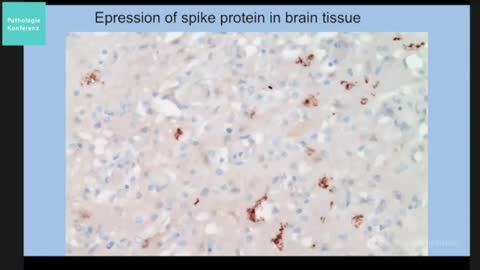 Spike Protein in Brain Tissue of 'Sudden Death' Post Vaccine Autopsy