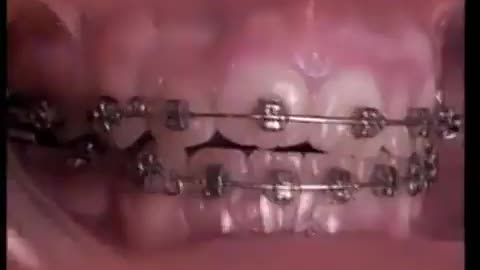 Time lapse of dental braces working