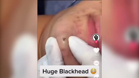 Pimple Popping Satisfying Video