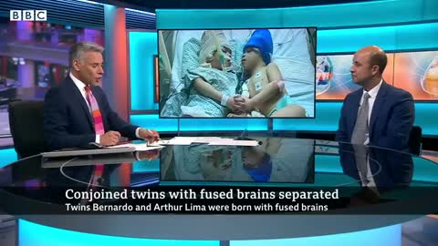 Conjoined twins separated with the help of virtual reality - BBC News