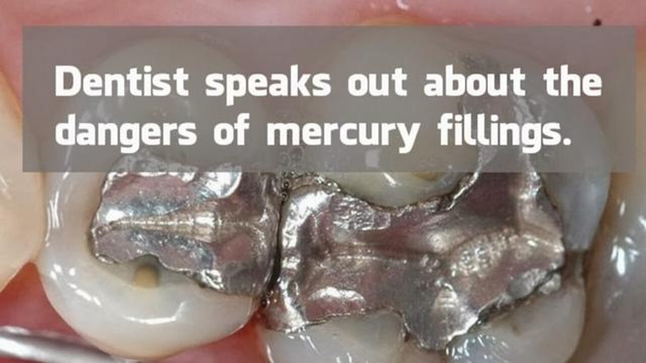 IF YOU HAVE MERCURY FILLINGS IN YOUR MOUTH THEN YOU NEED TO WATCH THIS...