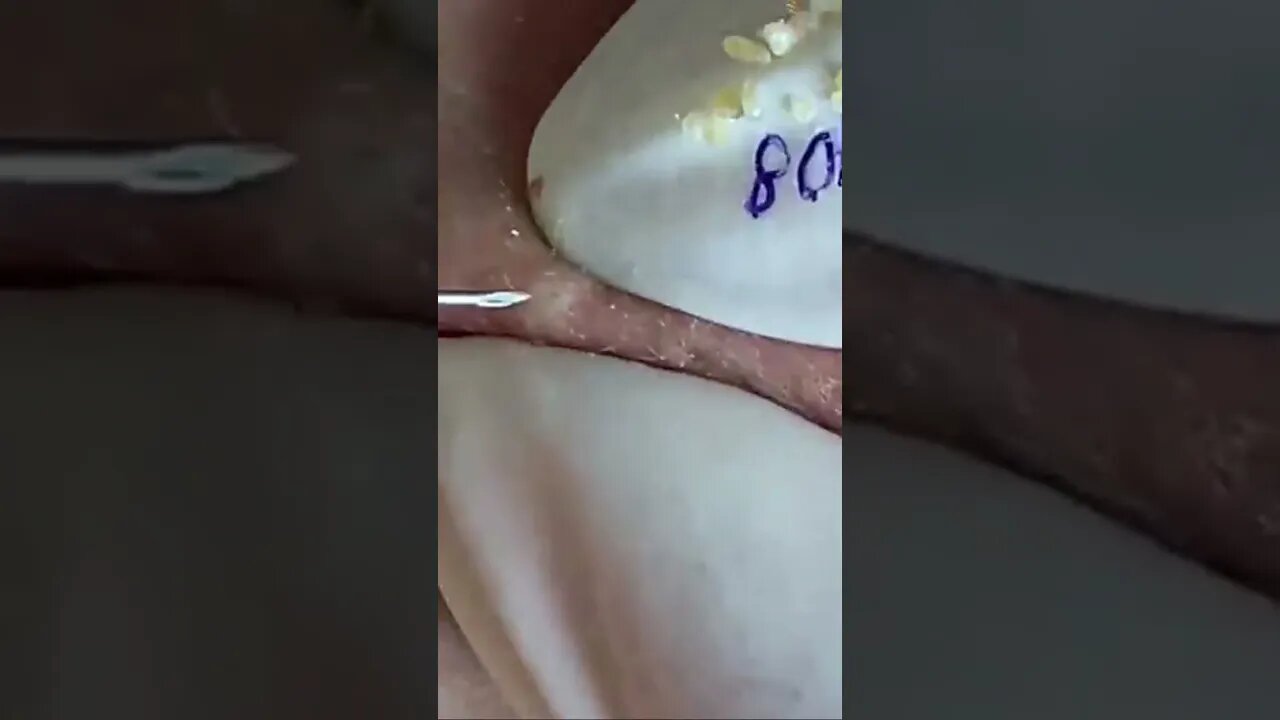 blackhead removal, blackheads, blackheads and acne, pimples removal, #short10