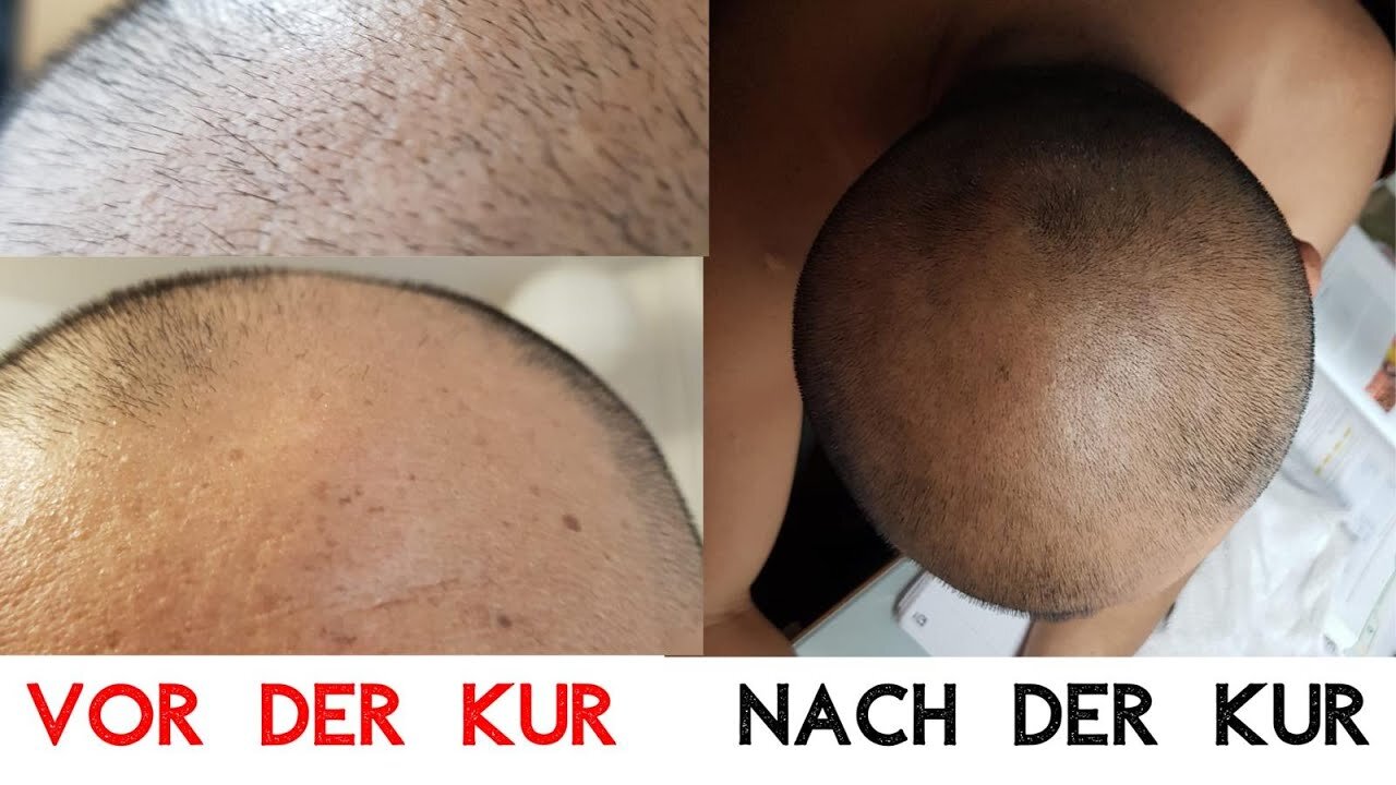 New Hairz - Neue Haare ohne Transplantation - Der lebendige Beweis - Mit Vorher - Nachher Bildern