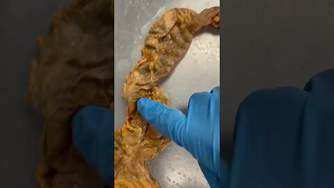 Where Humans Store Poop | Real Human Colon