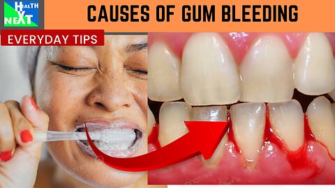 Causes of gum bleeding.