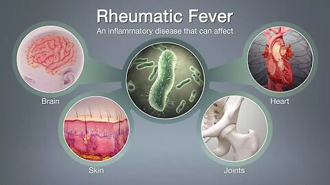 revised new Jones criteria for diagnosis of rheumatic fever