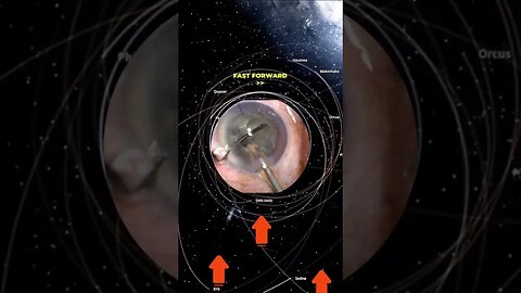 Eye surgery - scroll rott #nonsense #zoobox #eyes #cataracts #reddit #space