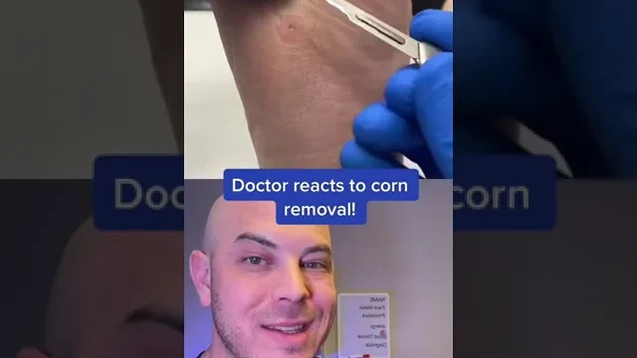 Doctor reacts to corn removal on the foot! #corn #itscorn #dermreacts